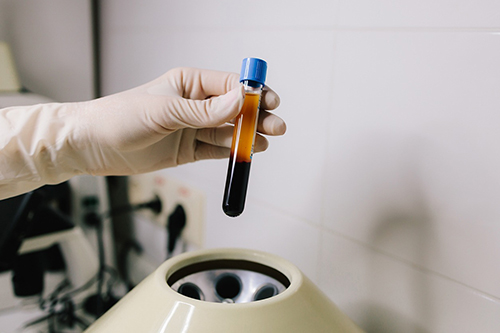 Is PRP Worth It? Houston Sports Medicine Experts Explain PRP Treatment Benefits