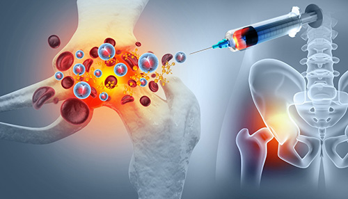 Musculoskeletal PRP Work in Houston