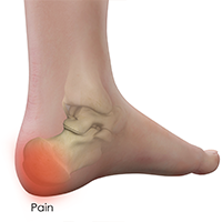 Foot Pain