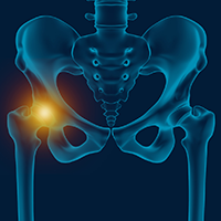 Hip Pain