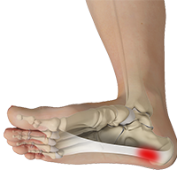 Plantar Fasciitis