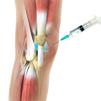 HA-Viscosupplementation Injection for Arthritis